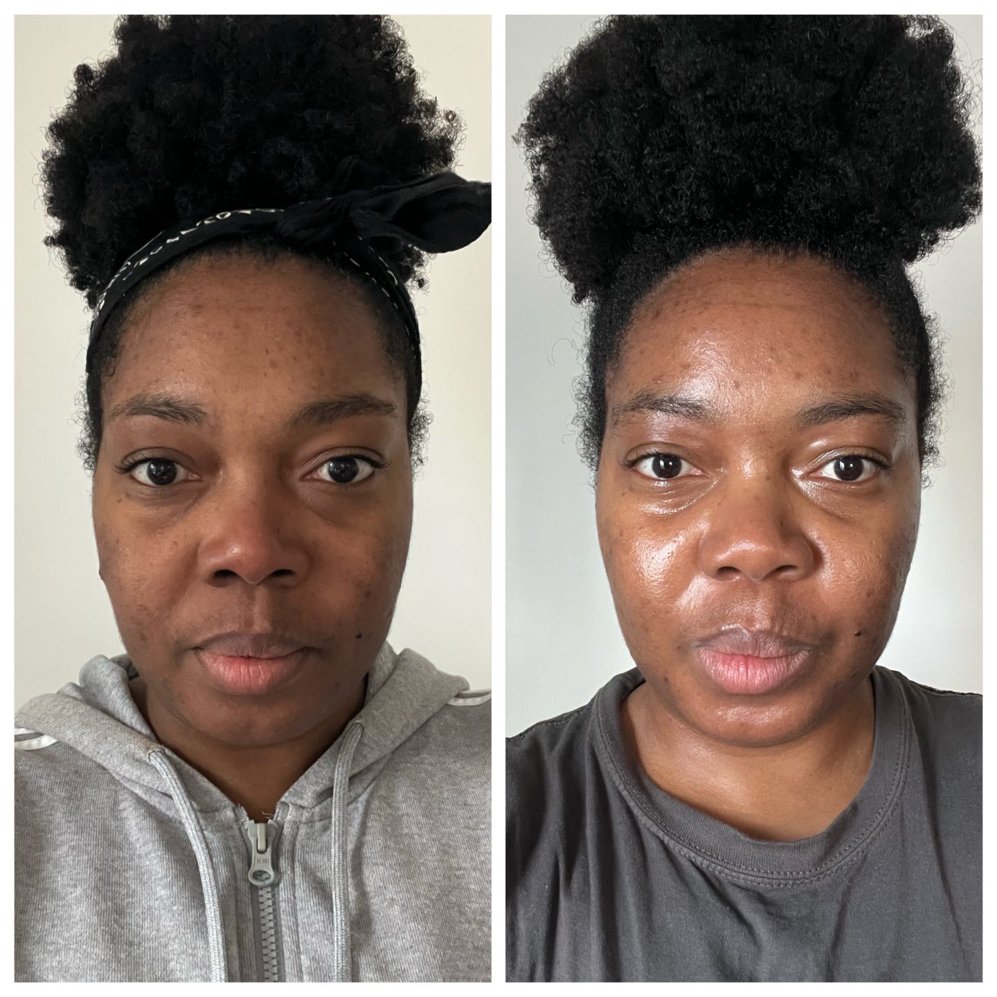 Dermatica for acne - one month in - front view 