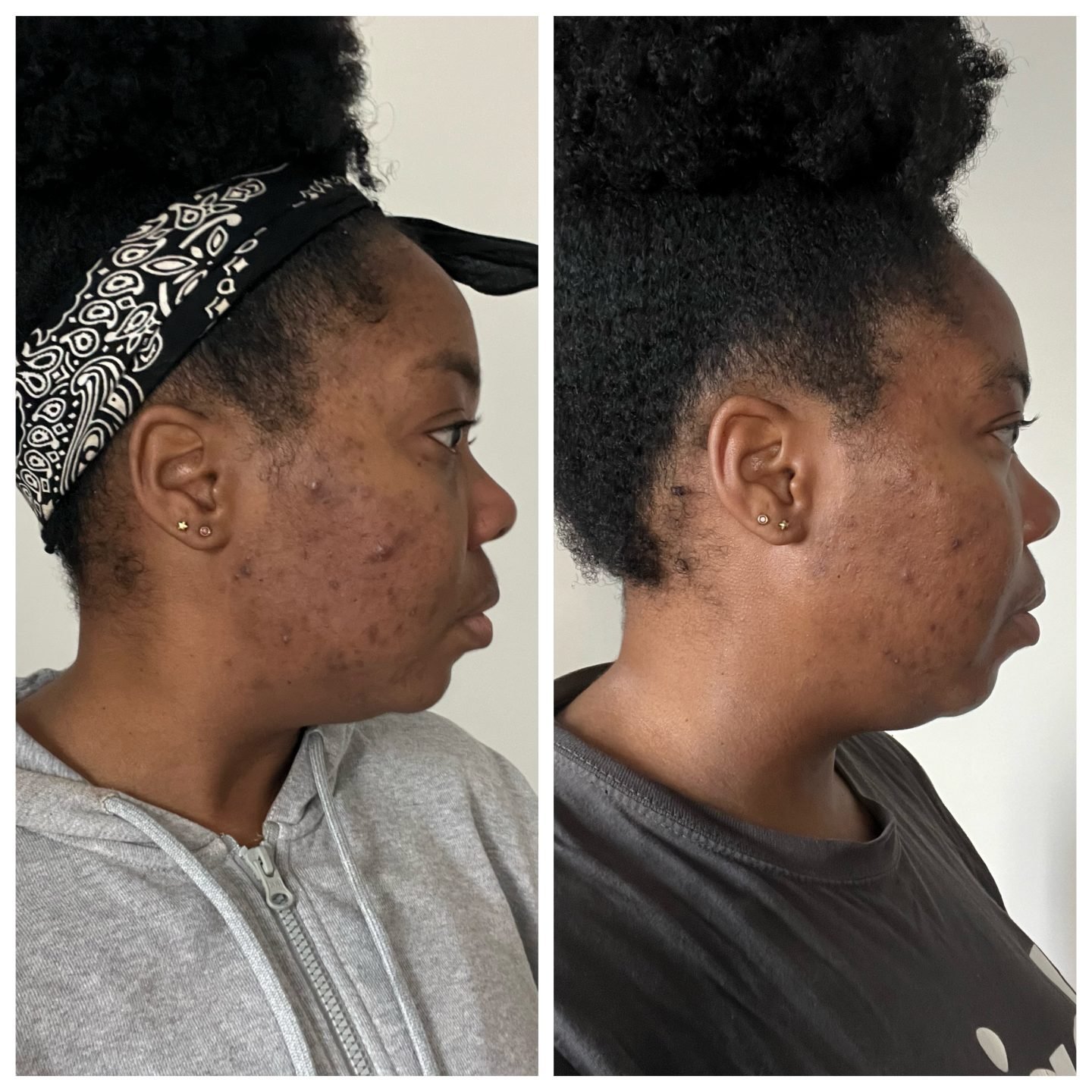 Dermatica for acne - one month in - side view one