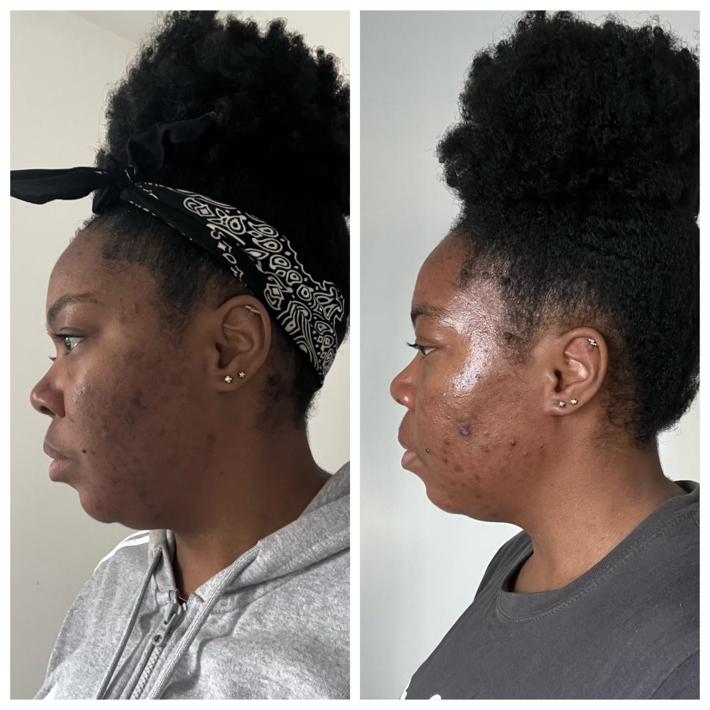 Dermatica for acne - one month in - side view two 